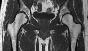 MRI פרקי ירכיים