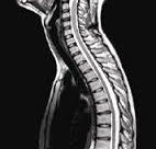 MRI עמוד שדרה צווארי